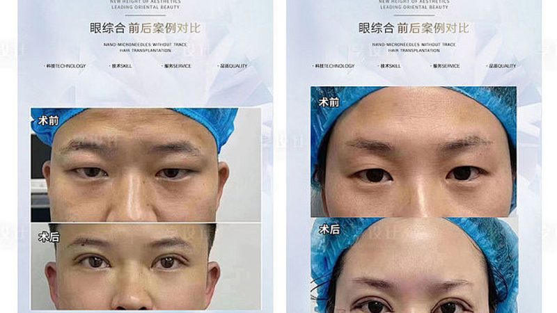 埋线与全切双眼皮：恢复时间差异揭秘