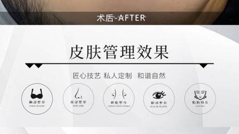 超声刀与埋线提升：揭秘维持时间的奥秘