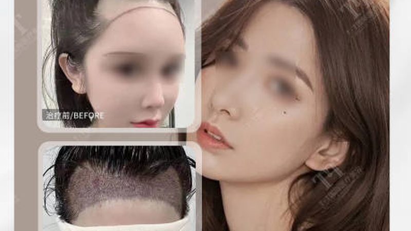 水光针与玻尿酸：揭秘注射美容的价格之谜**