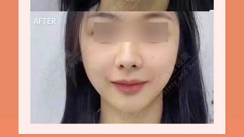 激光祛斑后，如何正确补水保湿？**
