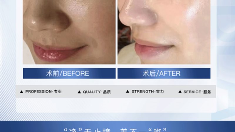 在进行割双眼皮手术前，求美者需要做好以下准备：