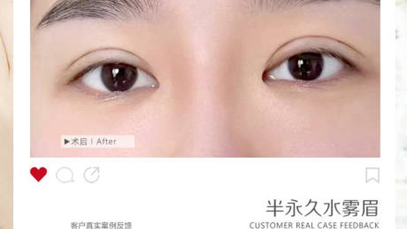 广州光子嫩肤团购，揭秘价格背后的真相