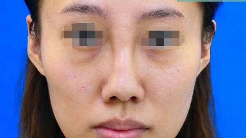 双眼皮修复：失败手术后的关键注意事项**